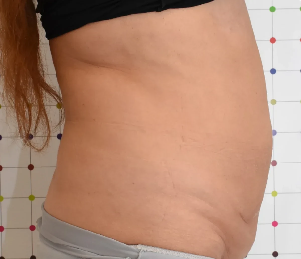 ONDA身体塑形 · 腹部与内衣边缘赘肉 · 完成1次治疗45天后