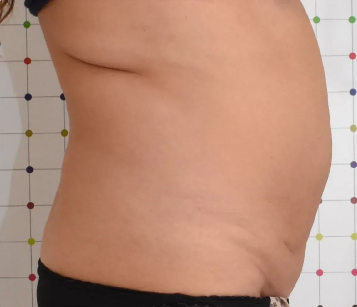 ONDA身体塑形 · 腹部与内衣边缘赘肉 · 治疗前（对比完成1次治疗45天后）