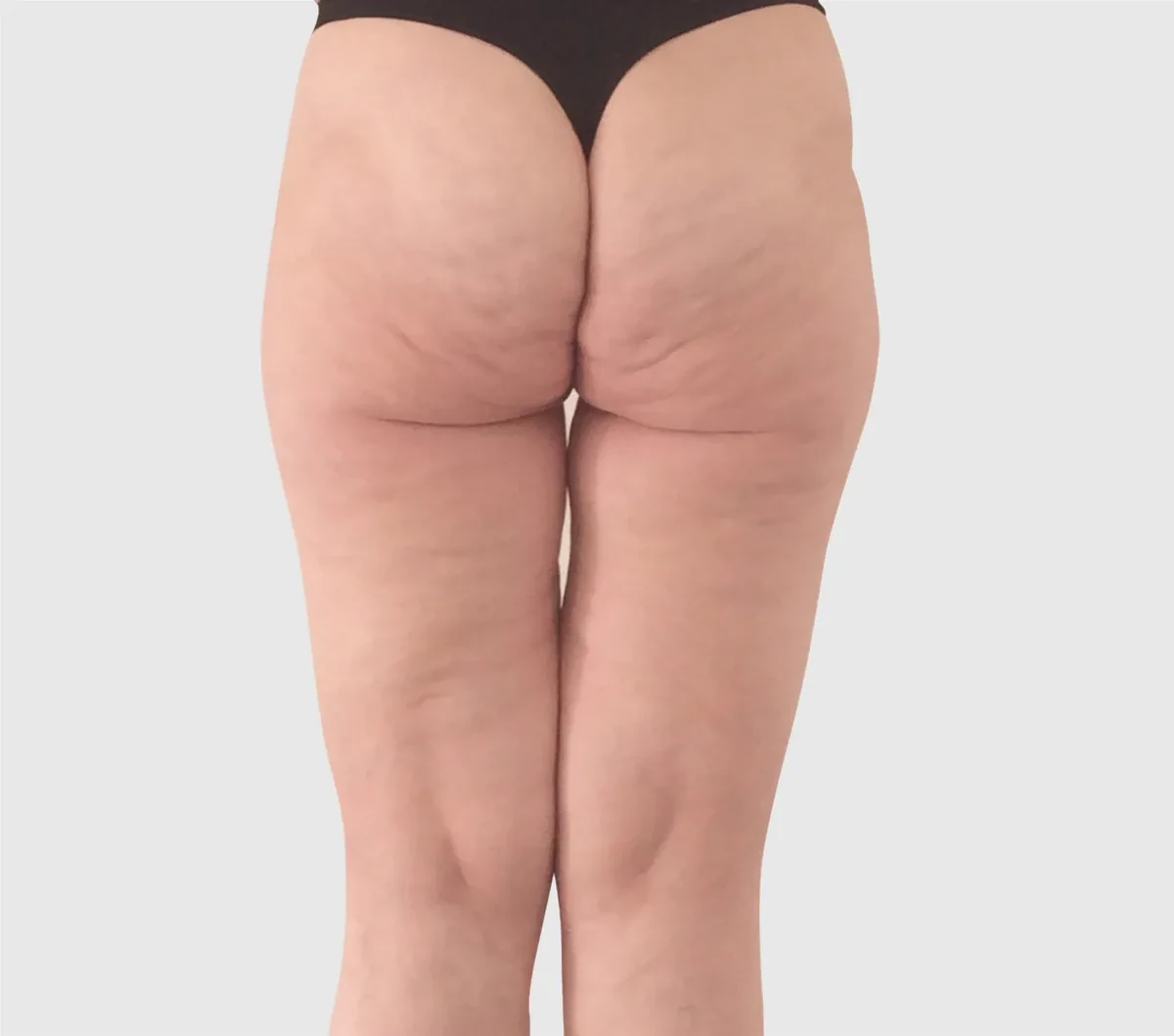 ONDA身体塑形 · 大腿外侧与臀部 · 完成1次治疗50天后