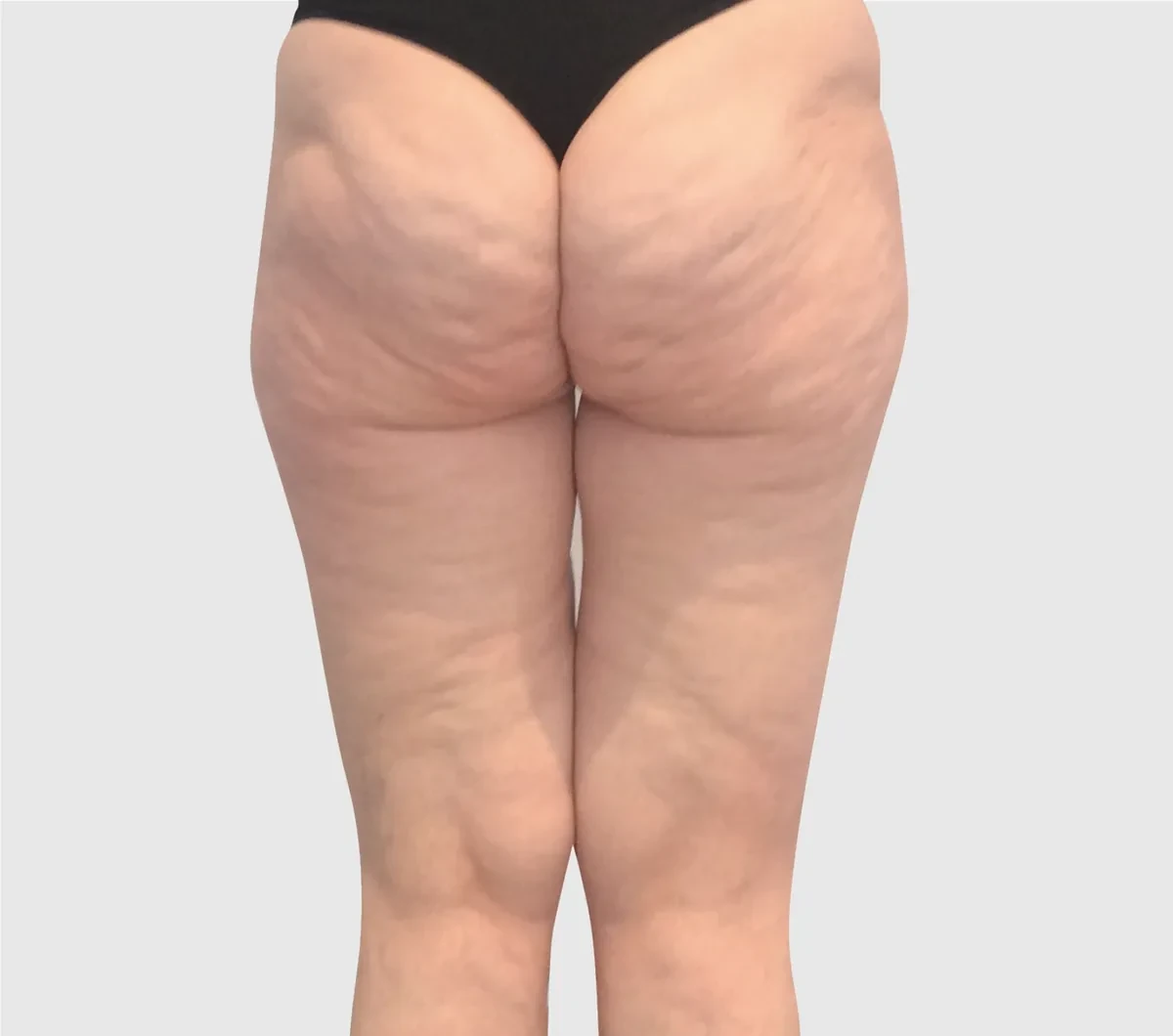 ONDA身体塑形 · 大腿外侧与臀部 · 治疗前（对比完成1次治疗50天后）