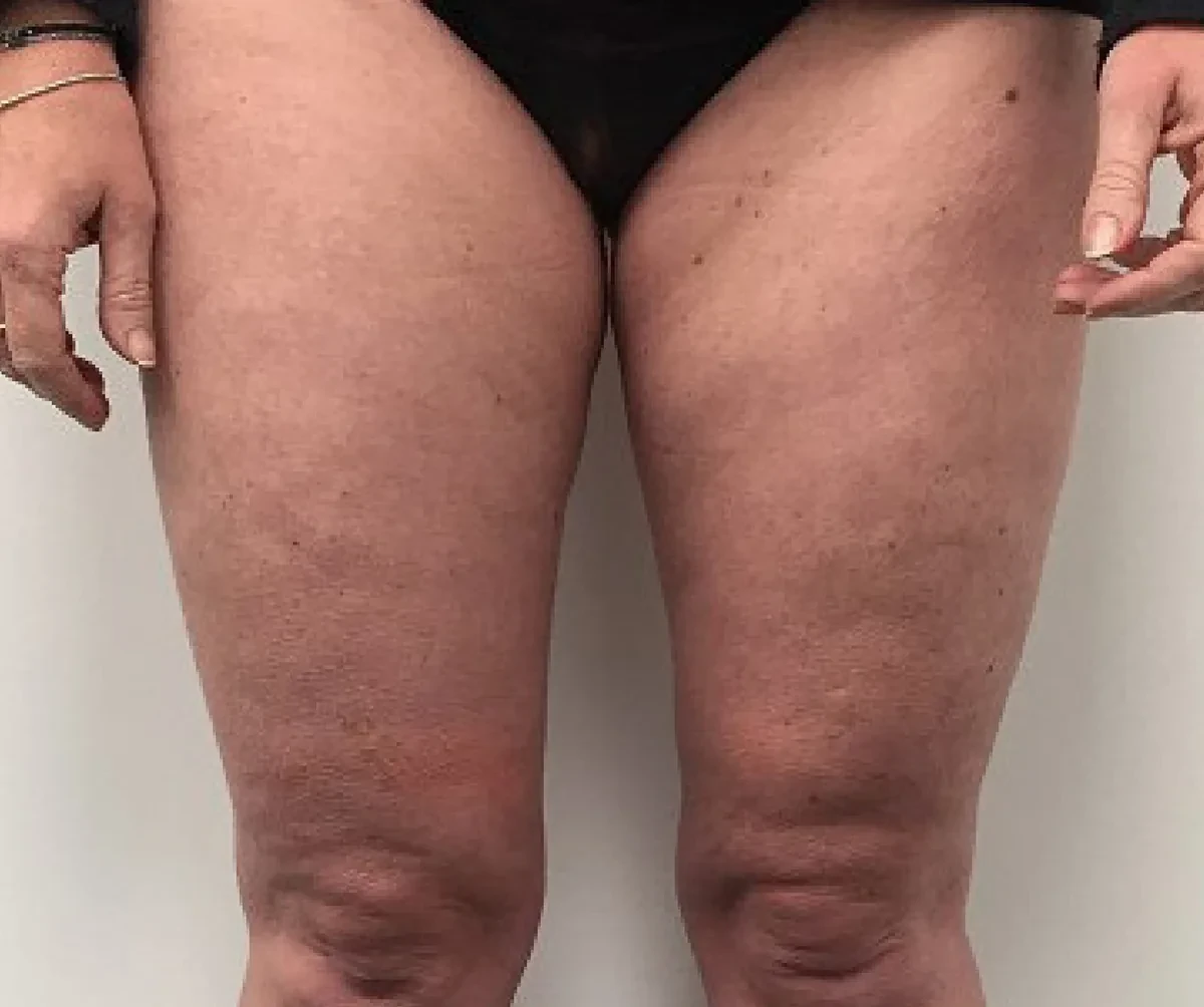 ONDA身体塑形 · 大腿与膝部 · 完成2次治疗后随访