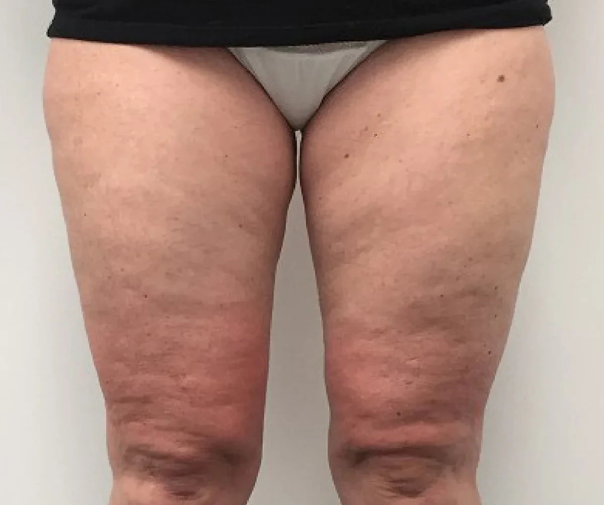 ONDA身体塑形 · 大腿与膝部 · 治疗前（对比完成2次治疗后随访）