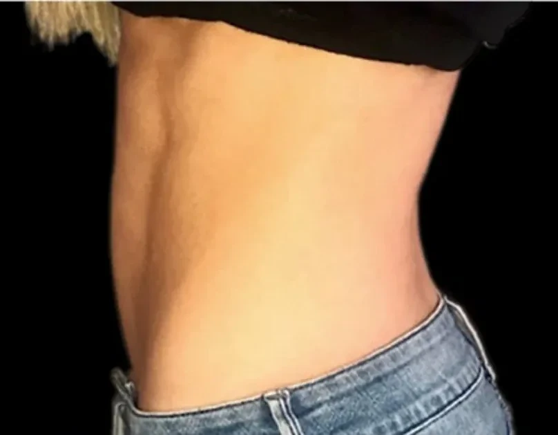 EMSCULPT · 腹部（女性） · 治疗后