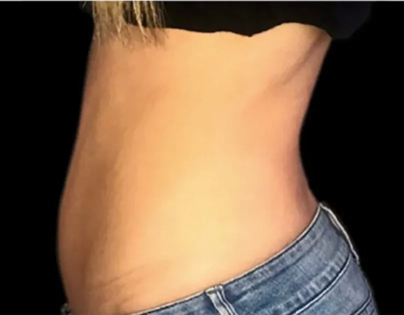 EMSCULPT · 腹部（女性） · 治疗前