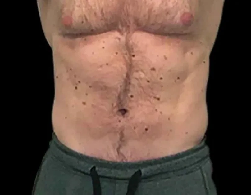 EMSCULPT · 腹部（男性） · 治疗后