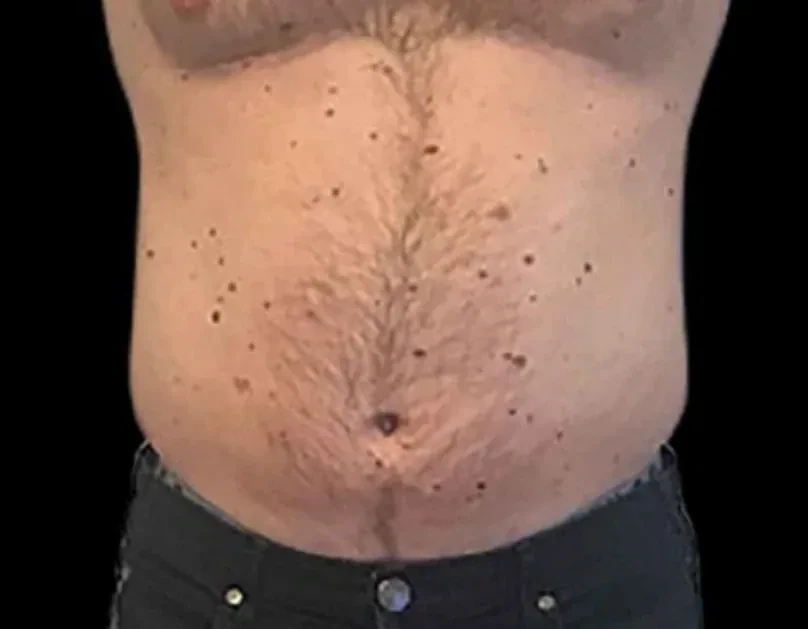 EMSCULPT · 腹部（男性） · 治疗前