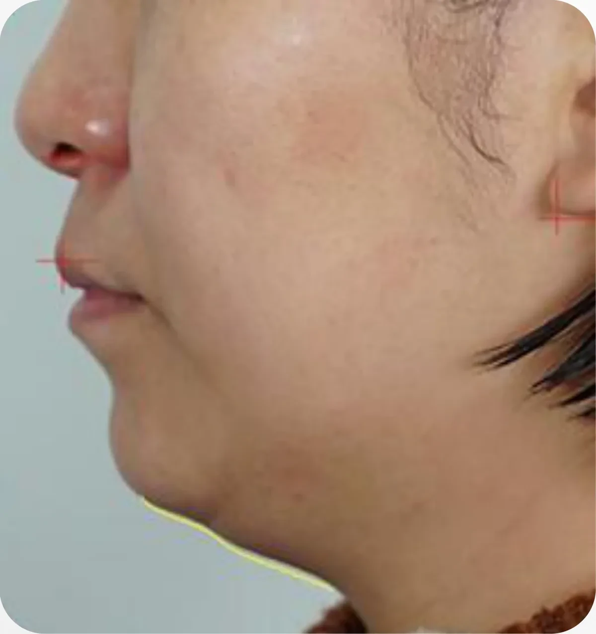 ULTLINE · 颏下轮廓 · 治疗前（对比治疗3周后）